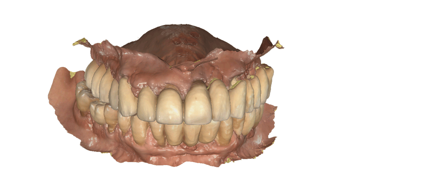הדמיה של השתלת שיניים
