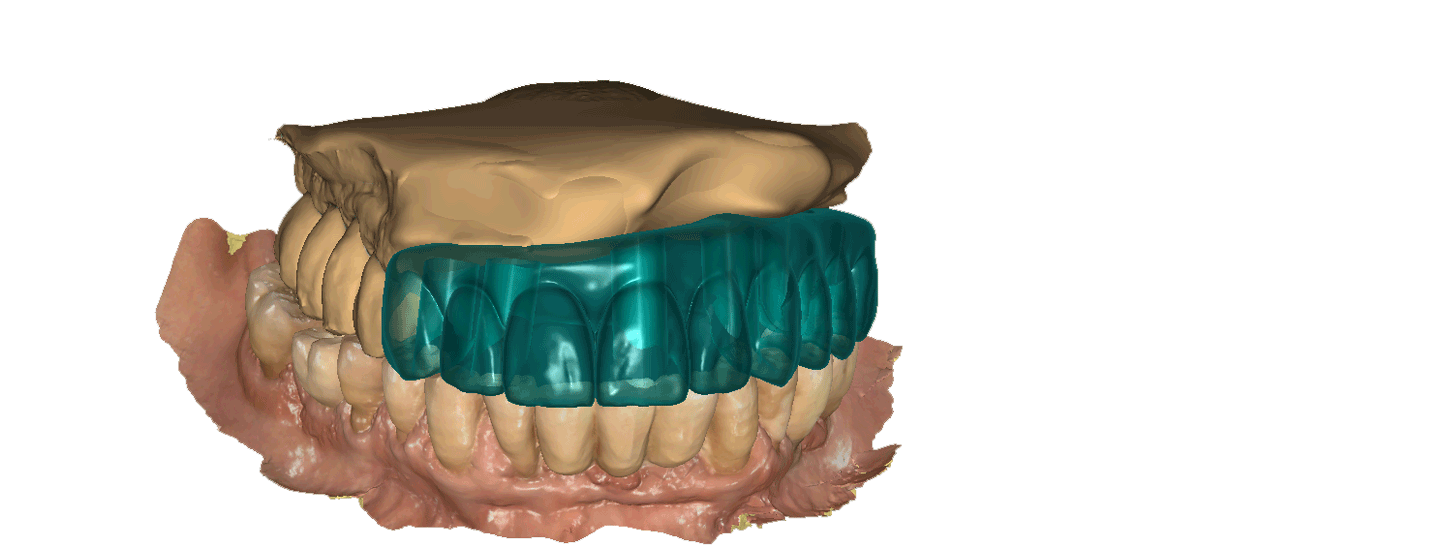 הדמיה נוספת של השתלת שיניים