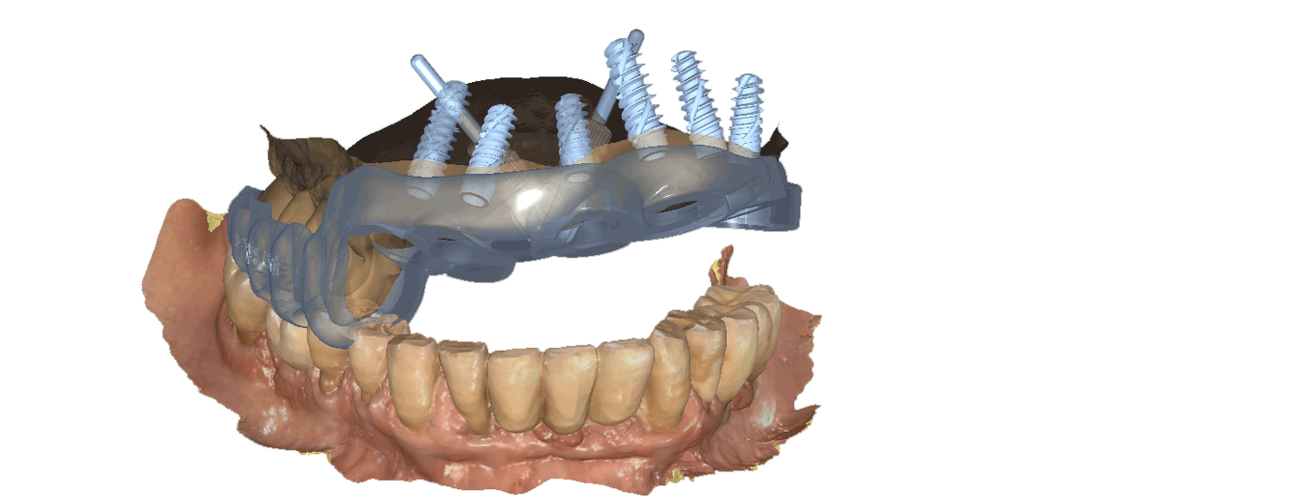 הדמיה שניה של השתלת שיניים