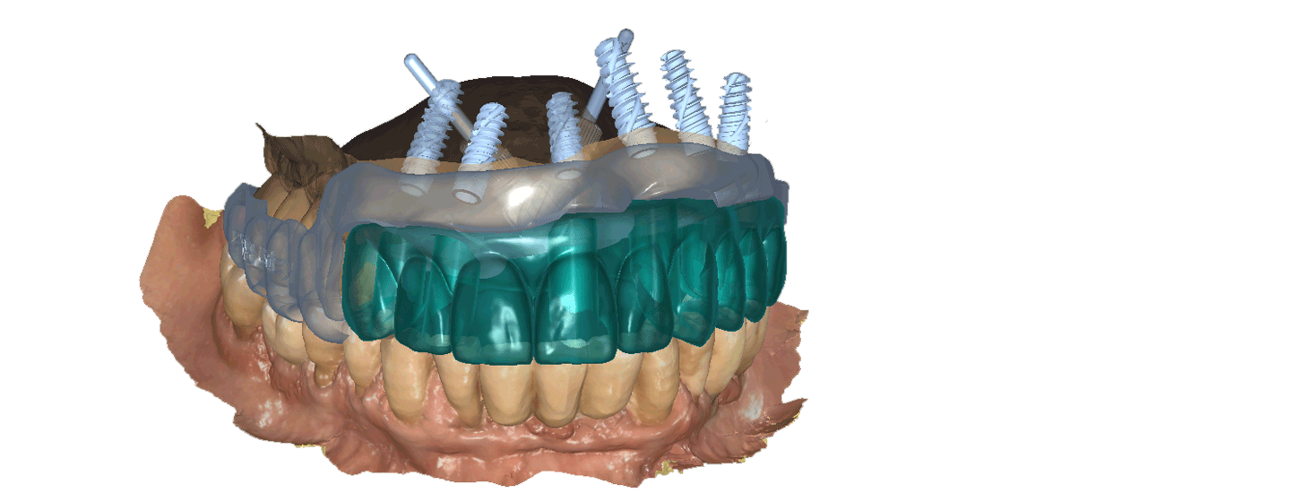 הדמיה נוספת של השתלת שיניים