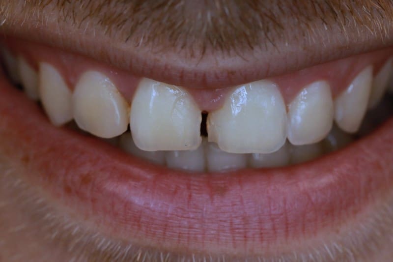 שחזור שיניים 11-21 על בסיס e-max, ציפוי קרמיקה - NonPrep